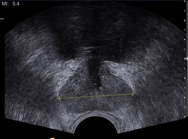 Ultrasound to check prostate health after taking Predstonorm