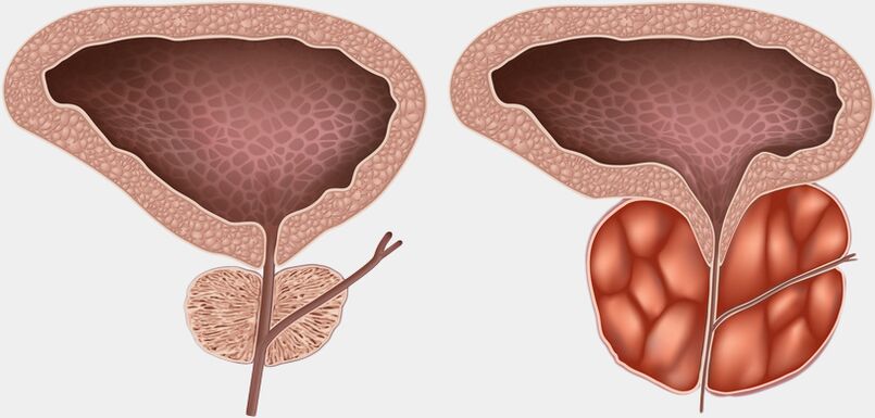 A healthy and inflamed prostate (with prostatitis)