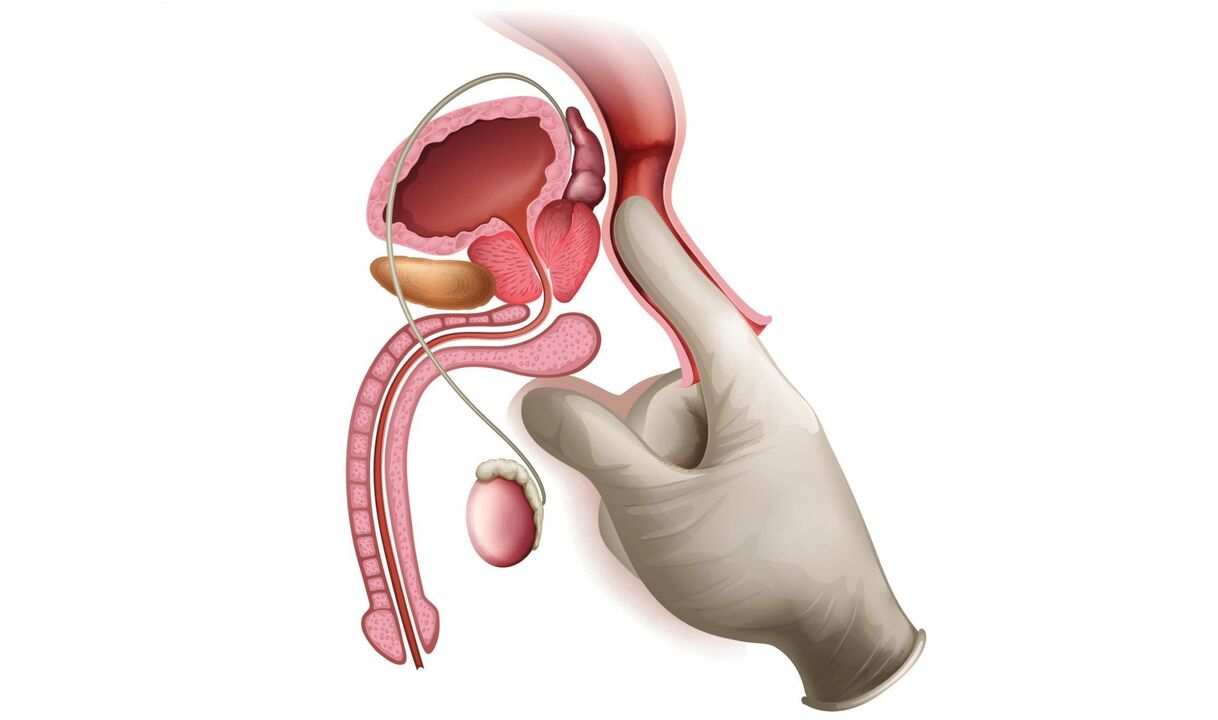 Prostate massage to treat prostatitis