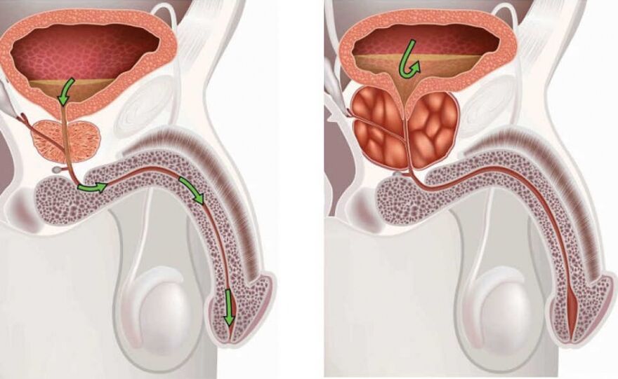 Men's Healthy and Diseased Prostate
